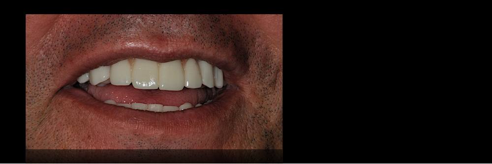 Il sorriso finale